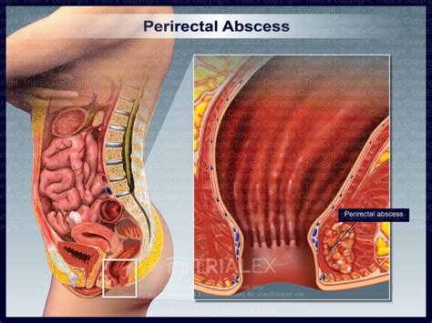Perirectal Abscess Trial Exhibits Inc