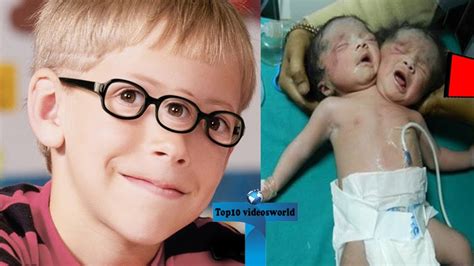 Top 10 Truly Unusual Kids Born With Extra Body Parts You Wont Believe