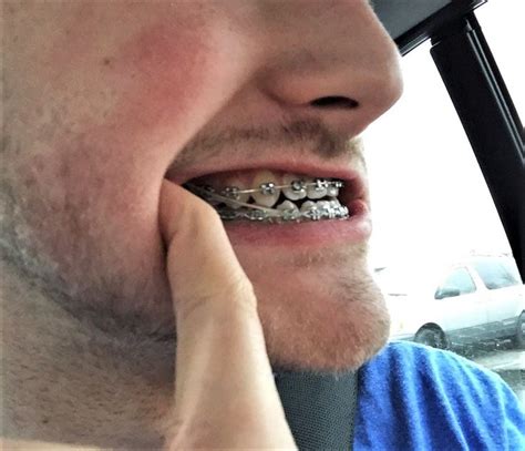 Pin By John Beeson On Guys In Braces Teeth Braces Orthodontics Braces Guys With Braces