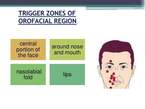 Trigger Zones Of Orofacial Region In Trigeminal Neuralgia