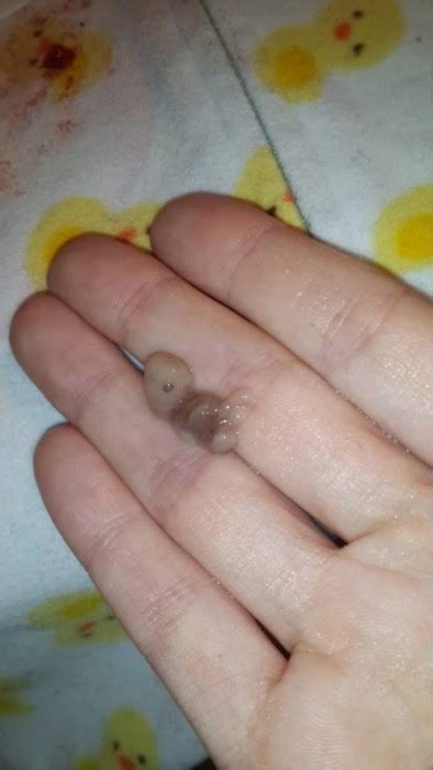 Photos Of Two Babies Miscarried At 7 And 8 Weeks Share The Truth