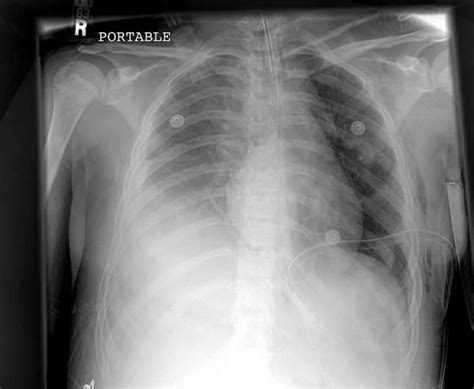 Postoperative Chest Radiograph Demonstrating Reduction Of The