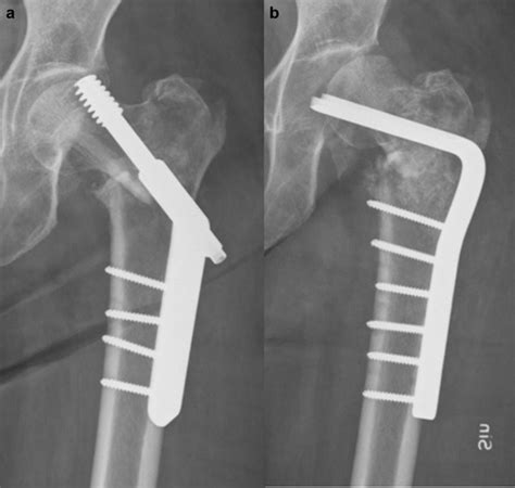 A Anteroposterior Radiograph Of The Left Proximal Femur After Failure