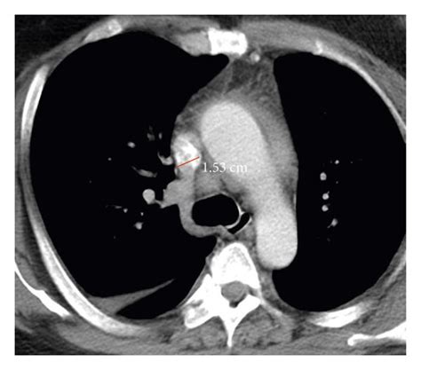 The Abdomen And Thoracic Ct Scan A Coronal Contrast Enhanced Ct