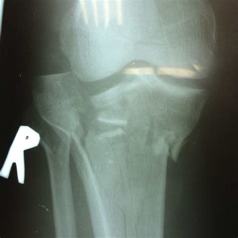 X Ray Of Bone Fracture
