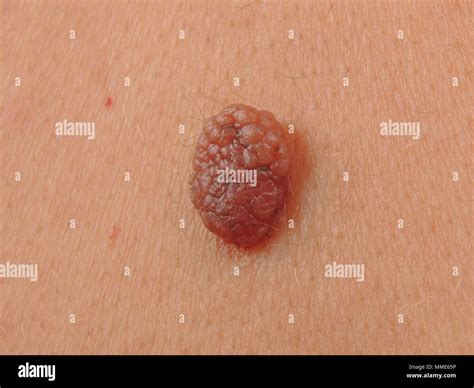 Benign Nevus Skin Dermatology Hi Res Stock Photography And Images Alamy