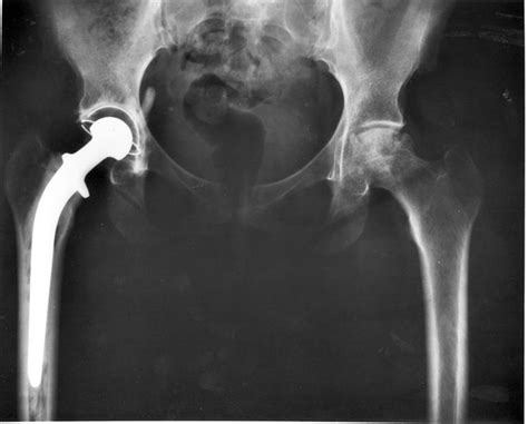 What I Learned About Total Hip Replacement Avascular Necrosis And