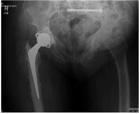 Cemented Constrained Total Hip Arthroplasty In A Patient With