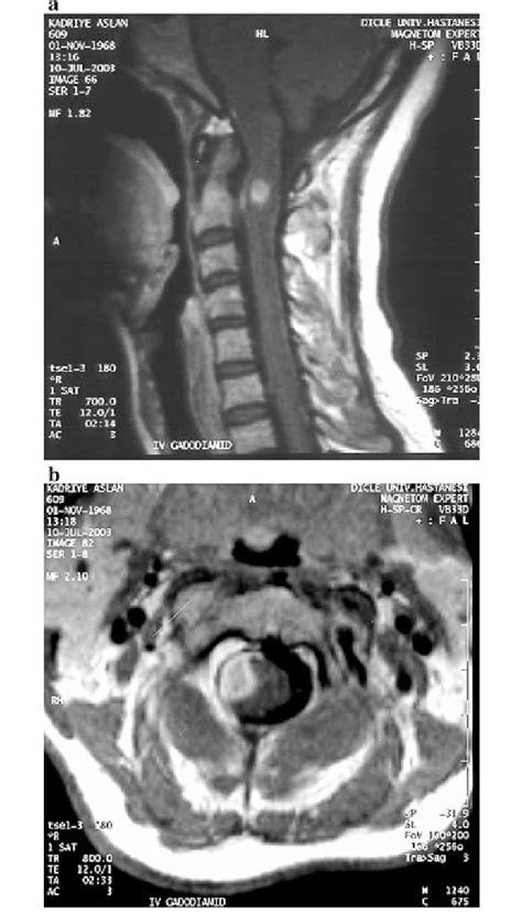 A B Contrast Enhanced T1 Weighted Sagittal And Axial Scans Demonstrate
