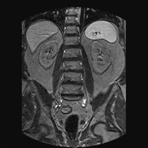 Mri Of The Kidneys Renalremakehealth An Mri Scan Of The Flickr