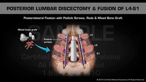 Posterior Lumbar Discectomy And Fusion Of L4 S1 Youtube