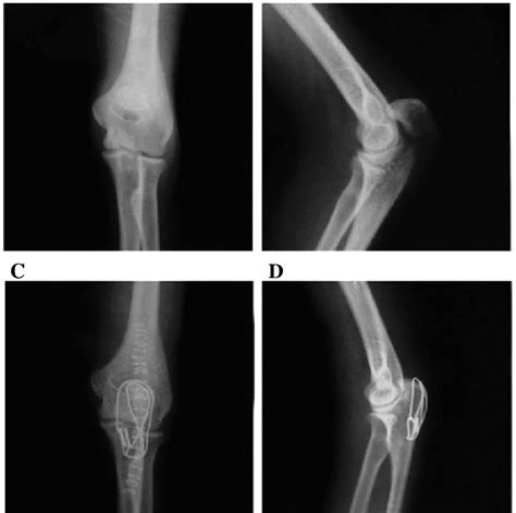 Representative X Ray Films Of Olecranon Fracture Patients Before And