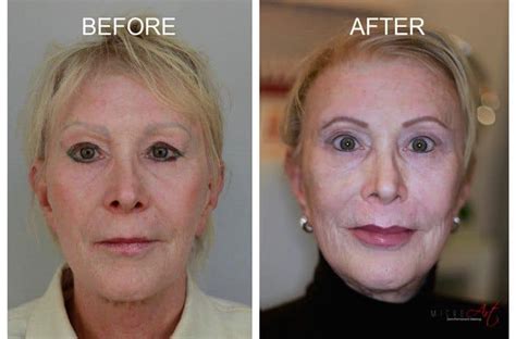 Permanent Makeup Before And After Care Mugeek Vidalondon