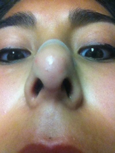 Small Red Bumps On Tip Of Nose Photo Doctor Answers Tips