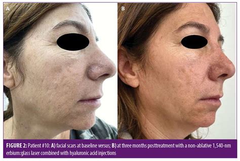 A Combination Of Non Ablative Laser And Hyaluronic Acid Injectable For