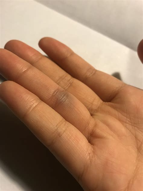 What Should I Do If My Finger Randomly Got A Bruise The Night Before My