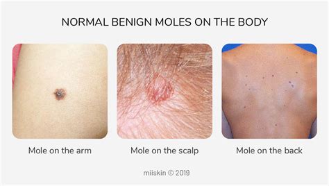 About Moles Types Warning Signs Causes And Prevention