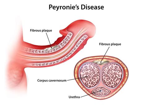 Curvatura Peneana CongÉnita O Enfermedad De Peyronie