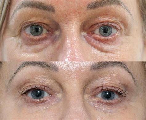 Best Tixel Eye Rejuvenation Australia Cutis Dermatology