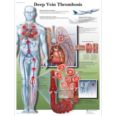 Vastral Physiotherapy Clinic Deep Vein Thrombosis Overview And Treatment