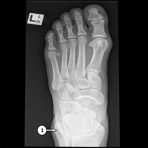 Foot Bones X Ray Cureus Chondromyxoid Fibroma Of Distal Phalanx Of