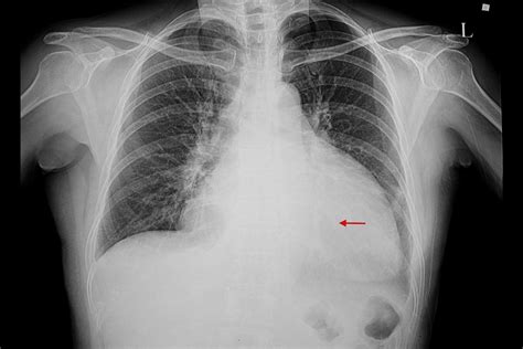 Enlarged Heart X Ray
