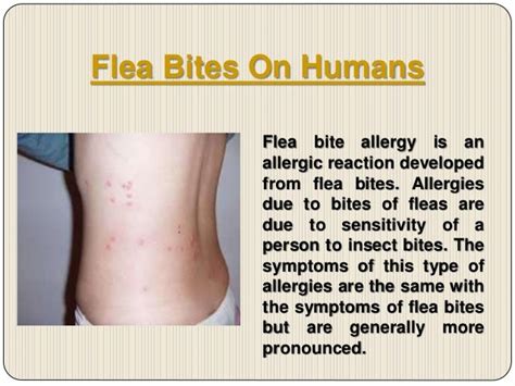 Flea Bites