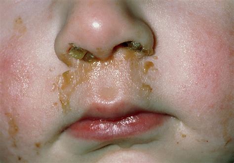 Rhinitis Mucus And Pus Discharge From Childs Nose Photograph By Dr P