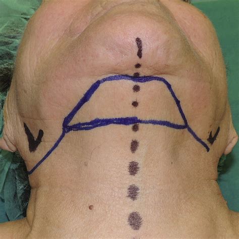 A Right Submental Flap Pedicle And Vascular Anatomy Of The Neck