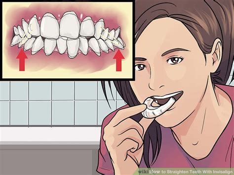 Invisalign invisalign braces are great for closing the gaps in your teeth as well as straightening crooked teeth. How to get rid of buck teeth without braces - IAMMRFOSTER.COM