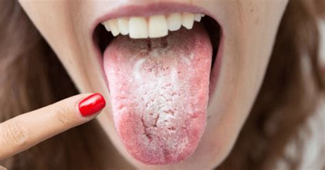 Oral Thrush Causes Symptoms And Treatment Apollo Hospitals Blog