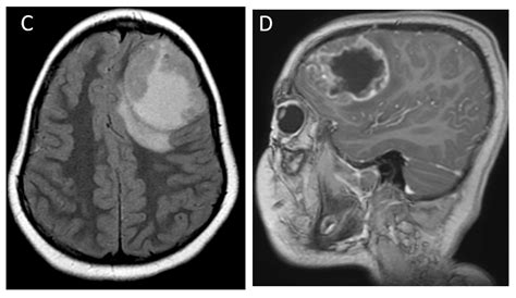 Diagnostics Free Full Text Mr Imaging Of Pediatric Brain Tumors