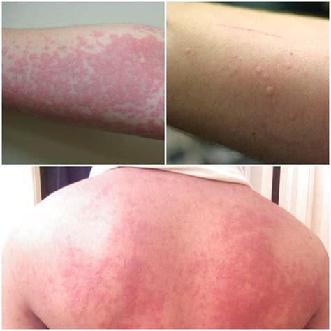 How To Get Rid Of Hives Urticaria Fast
