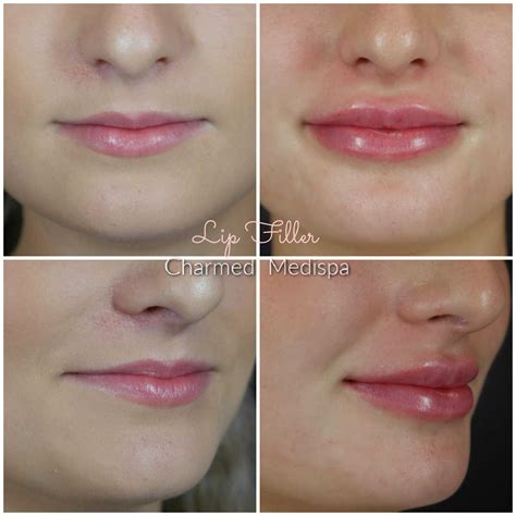 Lip Filler A Variety Of Techniques Charmed Medispa