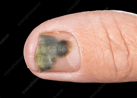 Pseudomonas Bacterial Nail Infection Stock Image C0374757