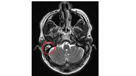 Cureus A Case Of Collet Sicard Syndrome Caused By Otitis Externa