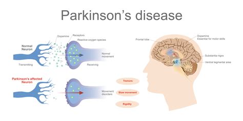 Parkinsons Disease Apollo Hospitals Blog