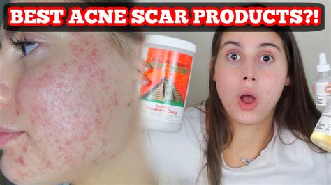 Best Products For Acne Scars And Skin Healing Youtube