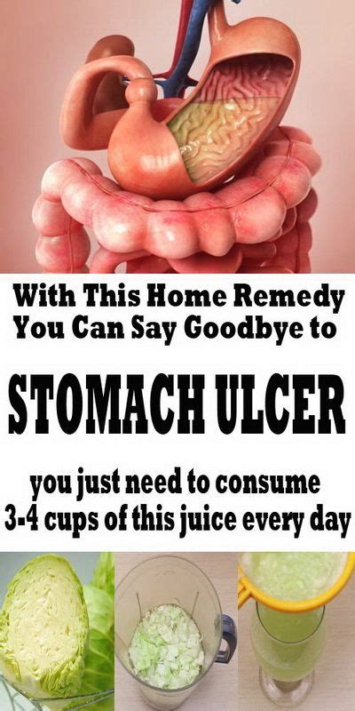 Natural Home Remedy For A Stomach Ulcer For Better Health Stomach
