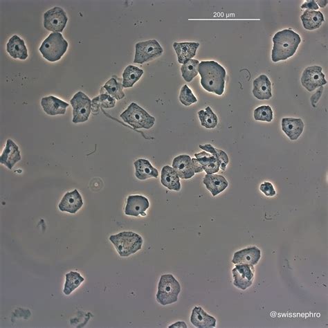Urine Sediment Of The Month 4 Flavors Of Nucleated Cells Renal