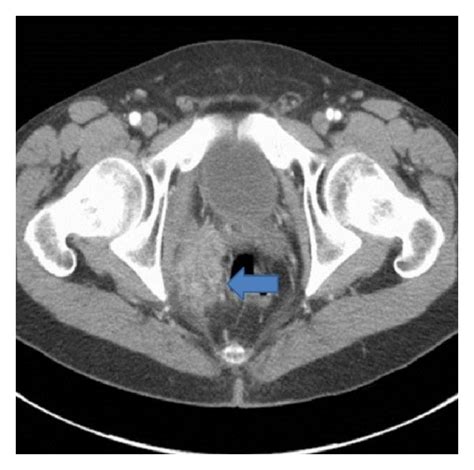 Contrast Enhanced Ct Scan Of The Pelvis Demonstrates A 65 × 51 Cm