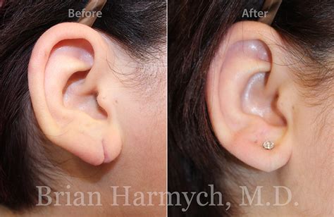 earlobe repair ear surgery cleveland oh