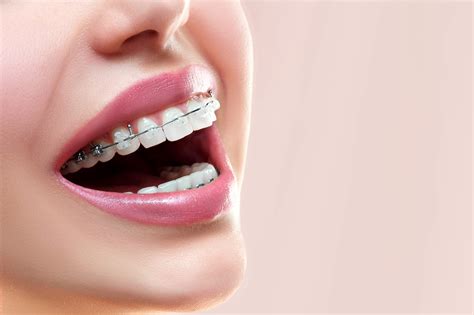 Dental Braces For Teeth Singapore Dental Essence
