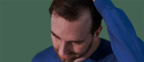 Read what dermatologists have to say before you what we know: Hair Loss Treatments: Do They Even Work? | Manual