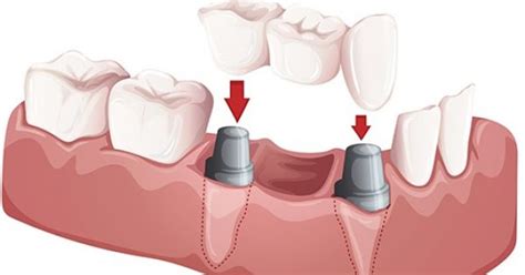 What Is A Bonded Dental Bridge Advanced Periodontics Nyc Nj