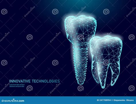 Molar Tooth Dental Implant 3d Low Poly Geometric Model Dentistry