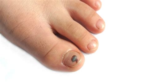 What Does It Mean When Your Toenail Turns Black