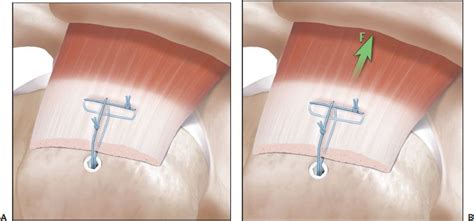 Managing Poor Tissue And Bone Quality In Arthroscopic Rotator Cuff