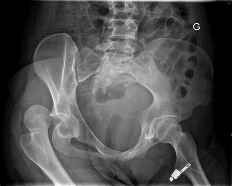 Recurrent Posterior Hip Dislocations On A Cam Type Femoroacetabular