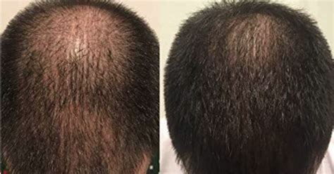 Product Spotlight Zenagen Revolve Hair Loss Shampoo Treatment For Men Tribeca Salons